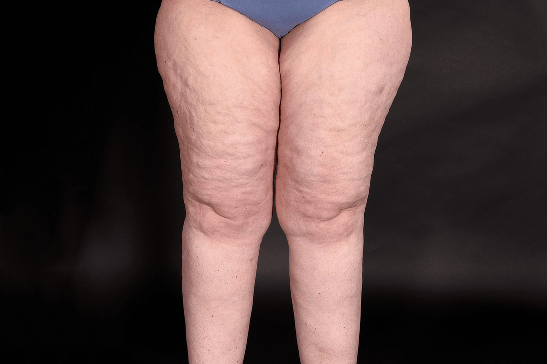 What is lipedema? All about the fat that's not your fault